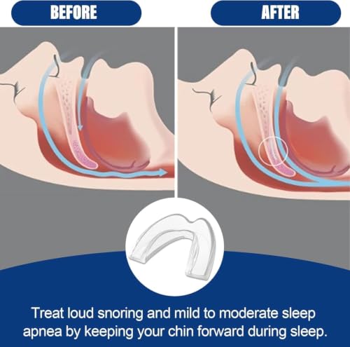 4 Gouttière Bruxisme Dentaire - Protège-dents Réutilisable Anti-Bruxisme | 2 tailles pour un ajustement parfait. Soulage le grincement des dents et améliore la qualité du sommeil. Facile à transporter