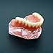 Dentalmall 1 Pc Dental Model #6001 01 - Overdenture Superior with 4 Implants Demo Model