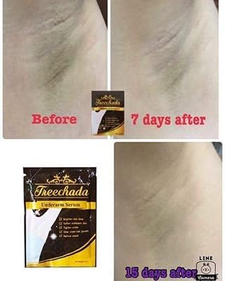 Treechada Underarm Serum Whitening Lightening For Armpit Elbow Knee Inner Thigh