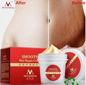 stretch mark removal amazon