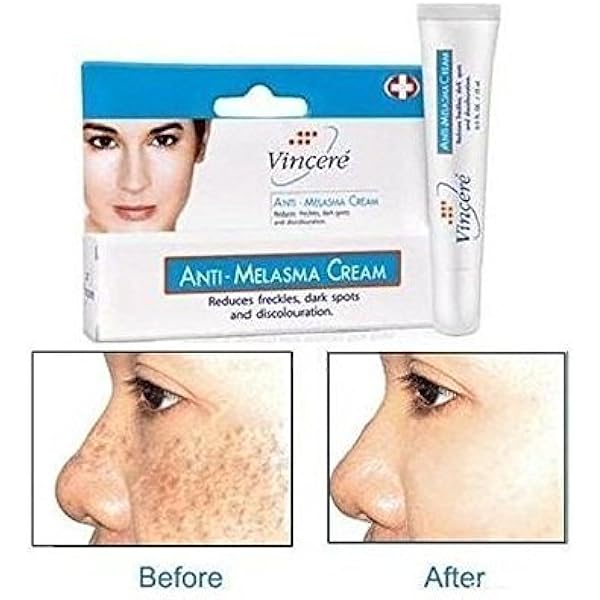 the spot cream for melasma