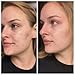 Natural Acne Cleanser - Gentle Face Wash To Clear and Control Acne Prone Skin - Tea Tree Oil, Aloe Vera & Gentle Essential Oils For A Refreshing Deep Clean - For Teens and Adults by Keeva Organics
