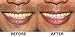 Dr. Brody's Premium Teeth Whitening System, Made Fresh in the USA, Dentist Approved! 14 Treatments