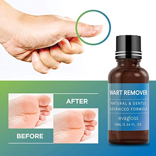 Natural Wart Remover, Maximum Strength, Painlessly Removes Plantar