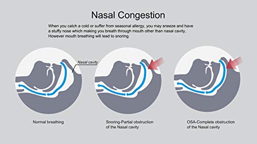 WoodyKnows Anti-Snoring Advanced Nasal Dilators Nose Vents to Ease Snoring and Breathing - Good Alternatives to Nasal Strips Chin Strap Jaw Strap Supporter (Multi-size Pack)