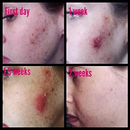 admire my skin 2 hydroquinone