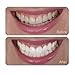 Go Smile Teeth Whitening System, 20 Count