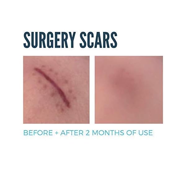 MD Performance Ultimate Scar Formula Advanced Silicone Scar Gel for