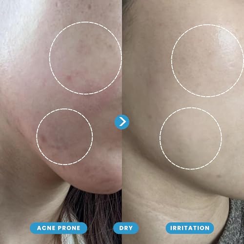 Hypochlorous Acid Spray – Dermatologist Tested HOCl Facial Cleanser for Sensitive, Acne-Prone & Irritated Skin – Soothes Redness, Eczema, Rashes & Itching – Skin Repair Spray, 60 ml + 200 ml - Honeydew Labs