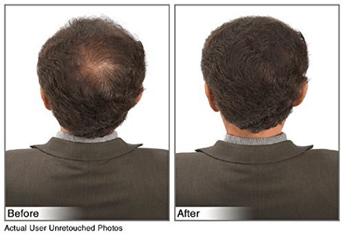 image for JUVEKER Hair Building Fibers Hair Loss Concealer for Men & Women - 28 
