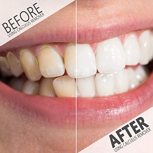 Tartar, Plaque Remover For Teeth Cleaning Kit - Ultrasonic Tooth Cleaner - Dental Calculus Remover - Removes Calculus, Stain, Plaque, Tartar - Teeth Cleaning Tool #1 (White)