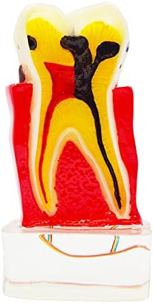 4 Times Periodontal Dental Model with Nerve Tooth Pathology Model