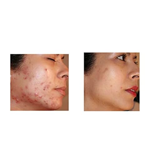 Organic Acne Treatment, Clear Skin is 100% Natural, Bezoyl Peroxide Free Acne and Scar Removal Cream with Tea Tree Oil, Quickly and Gently Removes Cystic, Hormonal, Adult, Body Acne and Pimple Scars Beauty & Personal Care, Skin Care, Face, Treatments & Masks