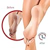 FLEXITOL-Heel-Balm-Medically-Proven-Treatment-for-Dry-and-Cracked-Feet-56g-Gives-Intense-Moisturisation Flexitol Rescue Heel Balm for Dry and Cracked Feet, Intense Moisturisation, Suitable for Diabetics - 56 g