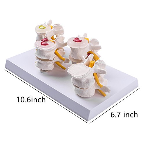 image for Zorvo 4-Part Anatomical Human Lumbar Vertebrae Degenerative Lumbar dis