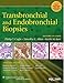 Transbronchial and Endobronchial Biopsies by Philip T. Cagle MD, Timothy C. Allen MD  JD