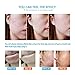 Acne Cleaning Cream,Acne Treatment Gel,Acne Removal Cream,Acne Gel Essence Skin Repair Face Cream,Natural Treatment Gel for Facial Blackhead Acne,Removes Spots Calms Inflammation