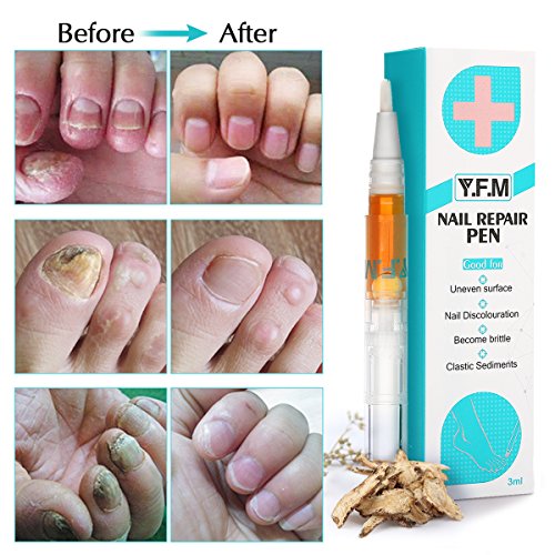 Fungal Nail Treatment Pen Y.F.M Antifungal Care, Effective Anti Fungus