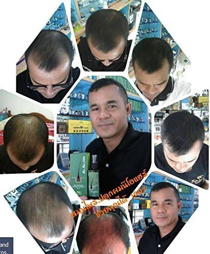 NEO HAIR GROWTH LOTION SOLVE BALD PROBLEM HAVE CONFIDENCE BACK RETURNING YOUNG AGAIN TREATMENT ROOT NUTRIENTS 100% SATISFACTION GUARANTEE MADE FROM MATERIAL REDUCE HAIR LOSS BALDNESS MEN