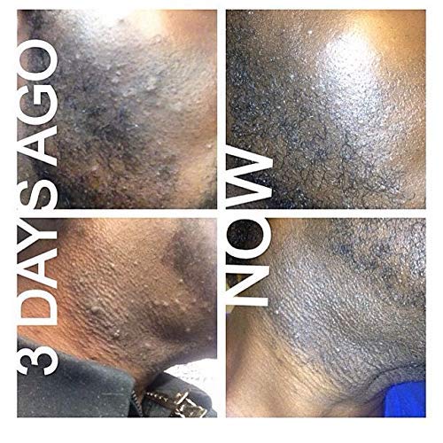 Pure Tropix Ingrown Hair Treatment Cream Razor Bump Cream Skin