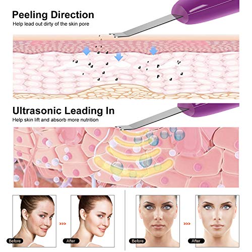 Facial Skin Scrubber TOPLANET Ultrasonic Skin Scrubber Peeling Extractor Cleaning Face Lift Blackhead Remover Facilitate Cell Metabolism for Anti-age Skin Care for Personal Salon Facial Care - Thumbnail 3
