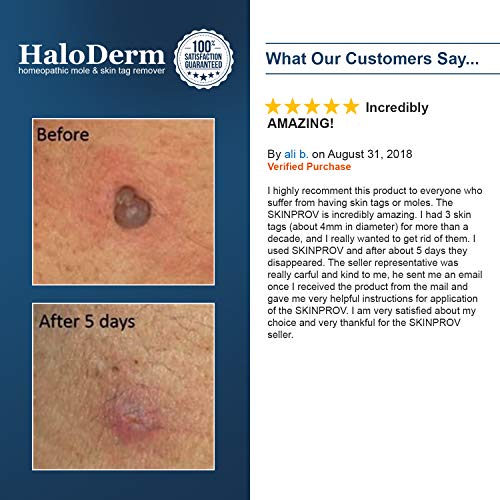 Skinprov Removes 4 Skin Tags. Low Cost Effective Skin Tag