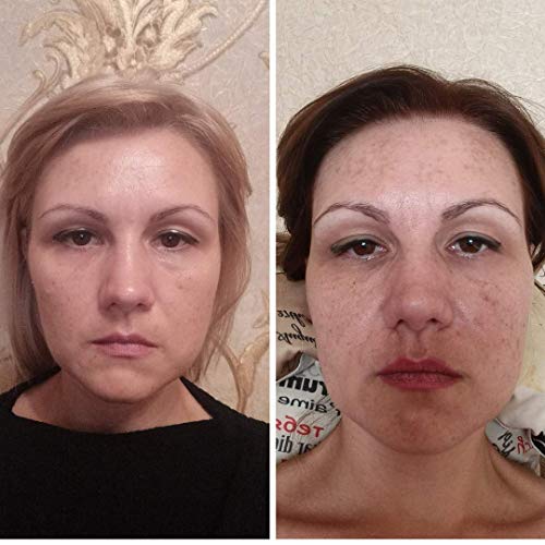 dark spot corrector for acne scars