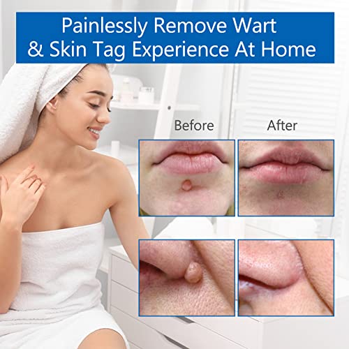 2 Size Automatic Removal Pen Set, Effective, Painless, Easy And Safe For Small To Large Size Warts And Moles (1-9 MM)