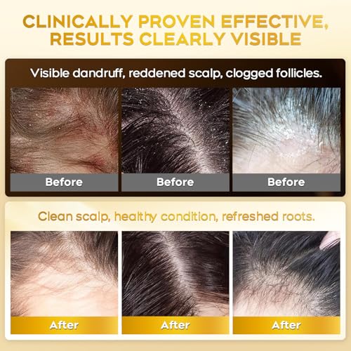oely Enhanced Antifungal Shampoo for Seborrheic Dermatitis, Folliculitis & Scalp Psoriasis – Anti-Dandruff Shampoo for Men & Women, Relieves Itchy Dry Scalp, Sulfate & Paraben-Free, 10.1 Fl Oz-Fresh