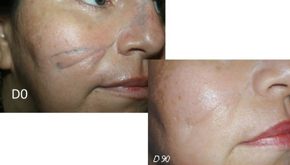 Sodermix for Treatment of Scars - 30g - Psoriasis Eczema Scars