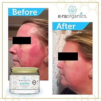 rosacea e acne