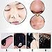 Nose Removal Blackhead Blackhead Cleansing Mask, 5Pcs Mineral Black Mud Nose Removal Blackheads Purifying Peel Acne Face Mask
