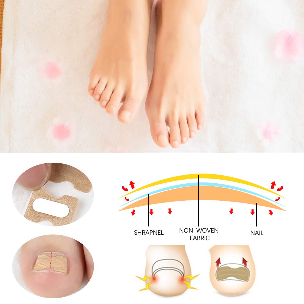DKAF 5 Sheets Glue Free Toenail Patch with 1 Pcs Nail Hook, Ingrown Toenail Removal Correction Patch Foot Nail Treatment Tool, Toenail Correction Sticker: Beauty