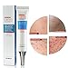 Acne Cleaning Cream,Acne Treatment Gel,Acne Removal Cream,Acne Gel Essence Skin Repair Face Cream,Natural Treatment Gel for Facial Blackhead Acne,Removes Spots Calms Inflammation