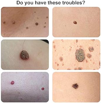 mole and skin tag remover