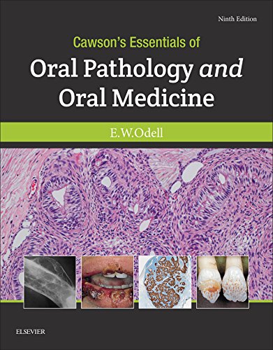 Download Cawson's Essentials of Oral Pathology and Oral Medicine E-Book
