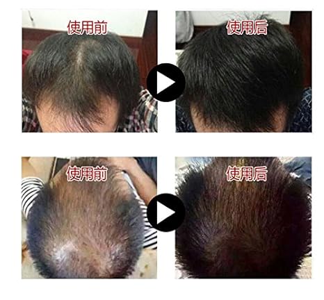 Buy Anti Hair Loss Ssrum Fast Powerful Hair Growth Products