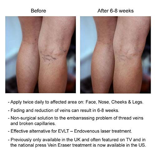 Verseo Vein Eraser for Varicose and Spider Veins & Rosacea Buy Online