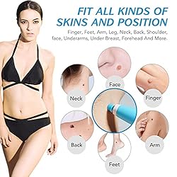 Skin Tag Remover, Upgraded 2 in 1 Skin Tag Removal