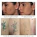 Picosecond Laser Pen - Remove Skin Tag Tattoo Speckles Mole and Spot Handheld Neat Cell Picosecond Laser Pen Upgraded Version