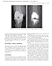 Total Knee Arthroplasty