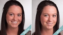 dermaflage acne scar filler