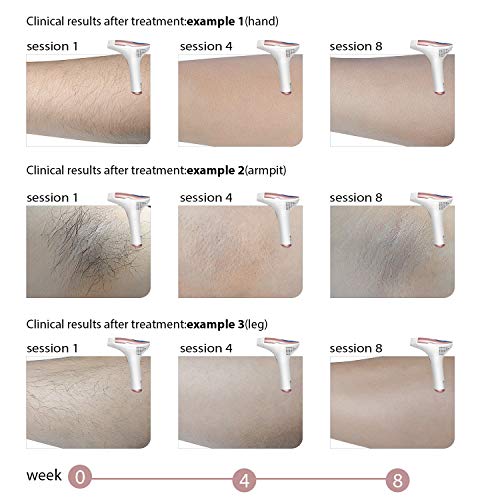 MLAY IPL Laser Hair Removal For Women Permanent Hair Removal Device - Professional 300,000 Pulse Home Body Hair Removal System - Thumbnail 2