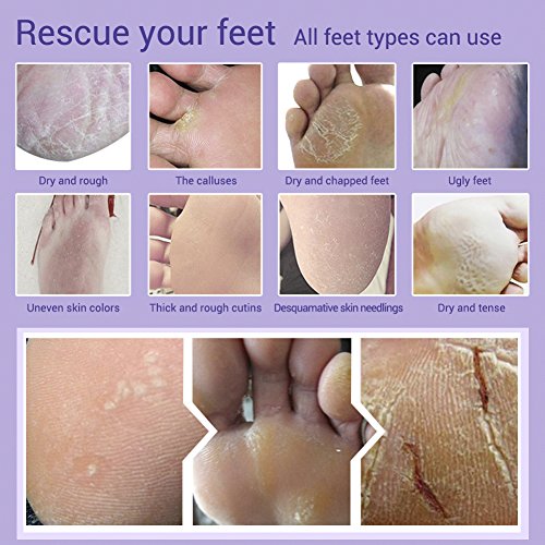 cracked heels baby foot