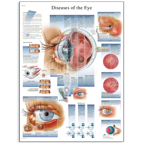 3B Scientific VR1231UU Glossy Paper Diseases of The Eye Anatomical Chart, Poster Size 20