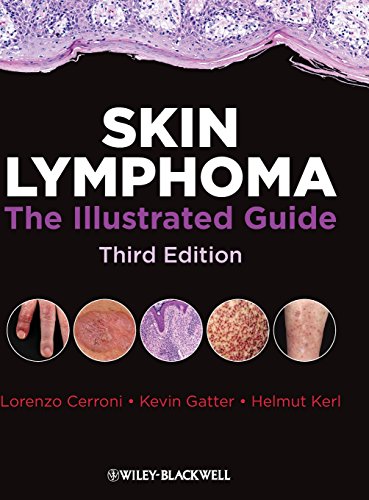 Skin Lymphoma: The Illustrated Guide