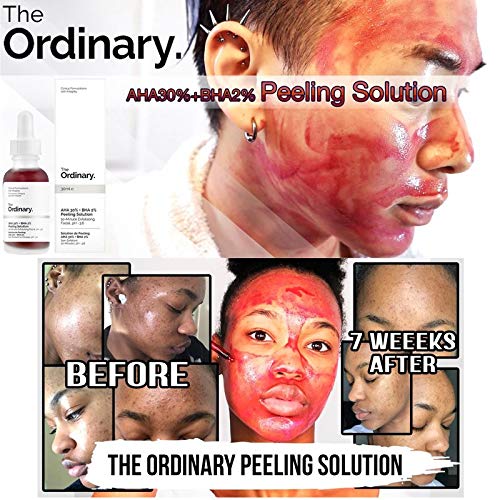 peeling ordinary acne