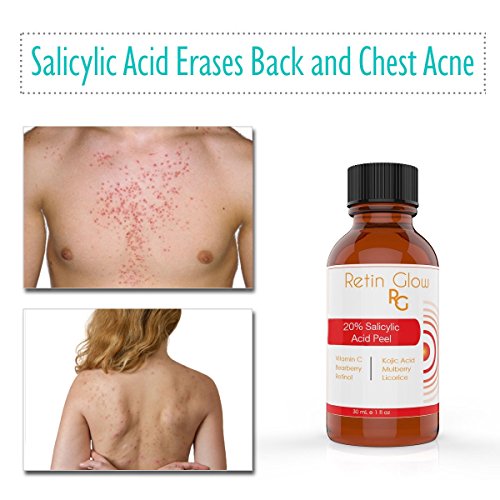 Salicylic Acid 20 Chemical Peel Including After Peel Neutralizer Ideal