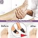Bunion Splints & Bunion Corrector - Bunion Brace for Hallux Valgus Bunion Pain Relief - No Surgery Bunion Splint - Corrector Bunion