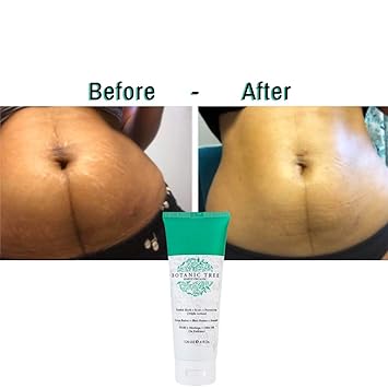 barmon stretch mark cream